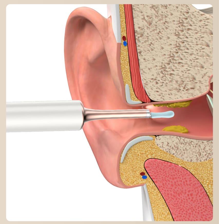 sredstvo za uklanjanje ušnog voska za čišćenje uha